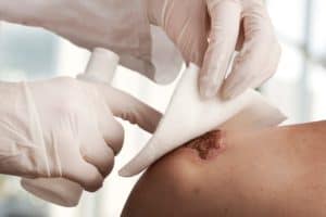 chronic wounds 2