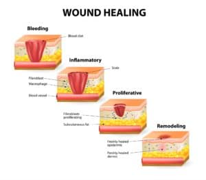 chronic wounds 3