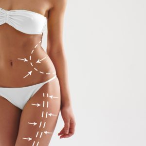 liposuzione laser