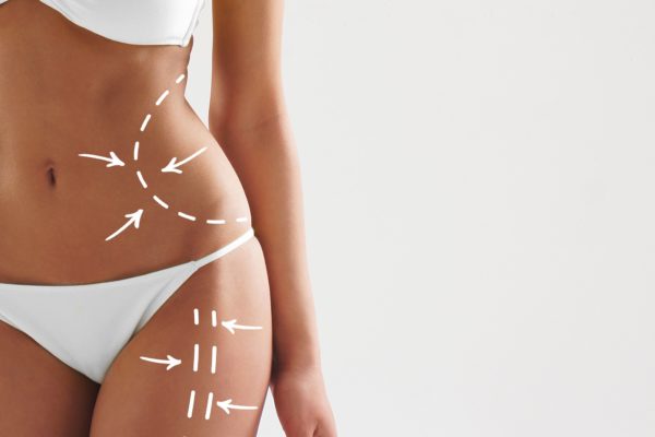 liposuzione laser