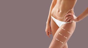 liposuzione laserliposuzione